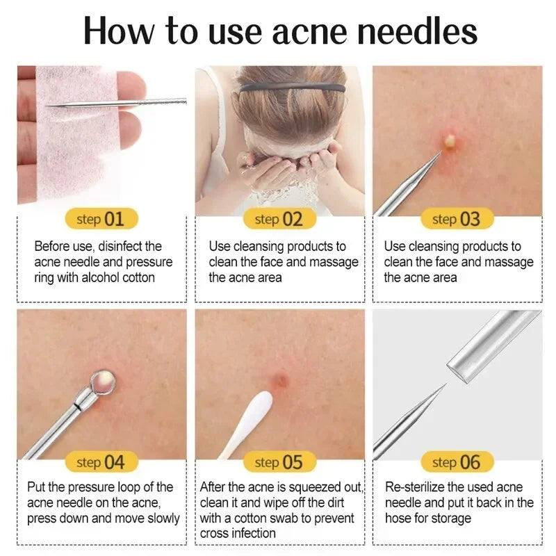 11-Piece Blackhead & Acne Removal Tool Set – Precision Tweezers & Extractors