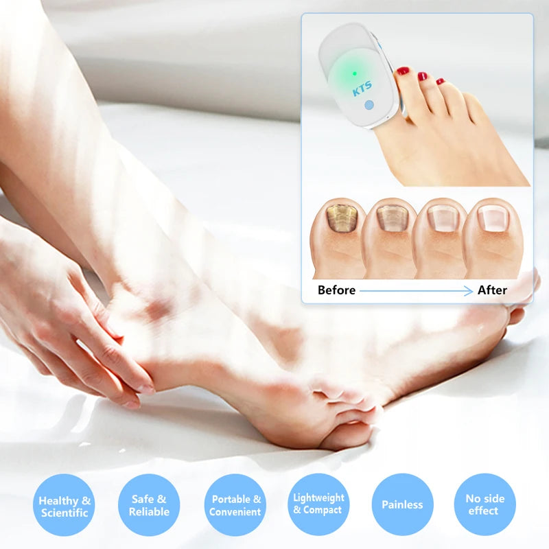 Nail Fungus Laser Treatment Device – 905nm & 470nm Dual Wavelength